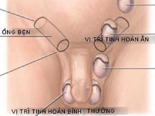 Tinh hoàn ẩn